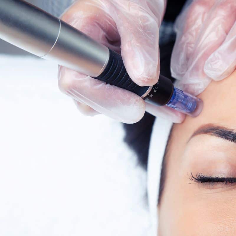 Morpheus8 treatment Feltham from Lipo Sculpt - Book in today!